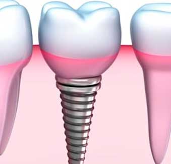 West 17th Avenue Dental | Dental Implants