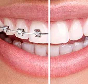 West 17th Avenue Dental | Orthodontic Dentistry